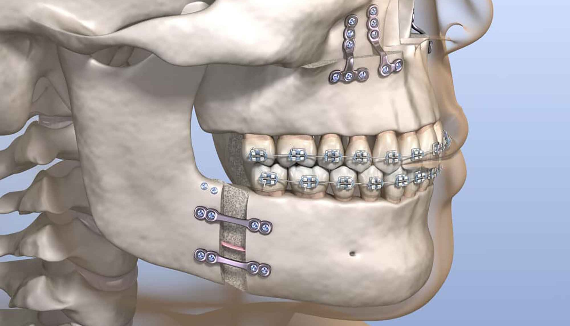 Corrective-jaw-surgery-illustration-1024x718_11zon-min