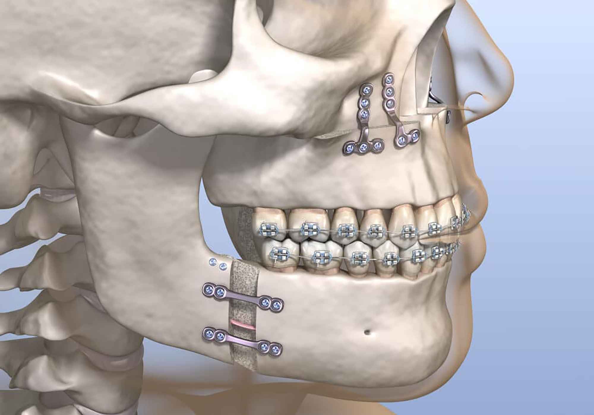 Minimally Invasive Surgery Instruments for Mandibular Surgery